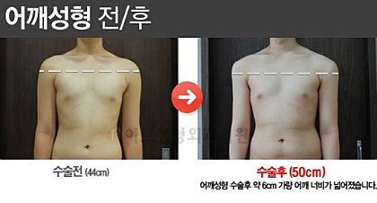 요즘 유행한다는 어깨수술.jpg | 인스티즈