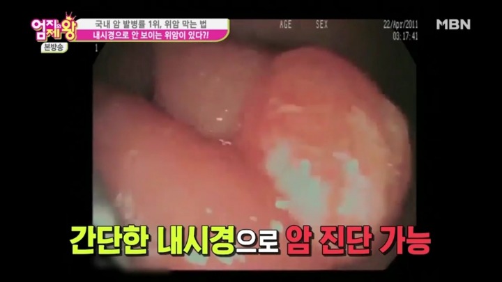 내시경으로 안 보이는 위암이 있다? | 인스티즈